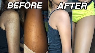 Watch How I Lighten and Get Rid Of My Dark Armpits FAST Before and After Results [upl. by Aitahs11]