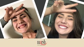 Incredible Smile Makeover With Gum Contouring amp Veneers  Dr Marsh DDS [upl. by Langille]