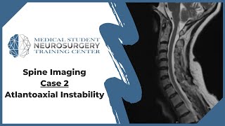 Spine Imaging Case 2 Atlantoaxial Instability [upl. by Lyris970]