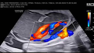 VSUM08092020CLS14 Placental Chorioangioma [upl. by Euf]