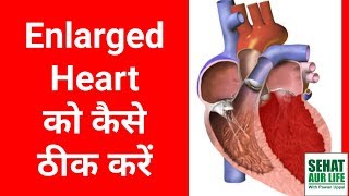 Enlarged Heart को कैसे ठीक करें In Hindi [upl. by Lally738]