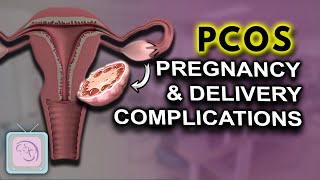 PCOS Pregnancy complications  High risk  Birth Defects [upl. by Natsirk999]