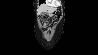 transverse colon cancer [upl. by Ahsercal]