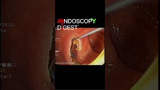 Complete biliary endoscopic sphincterotomy shorts [upl. by Sauveur]