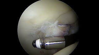 Articular Cartilage with a Grade 3 Injury to the Posterior Acetabulum near full thickness [upl. by Dianemarie167]