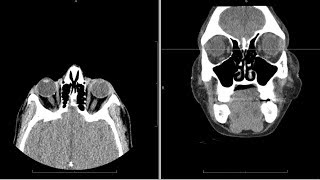 CT computed tomography face radiology search pattern [upl. by Madora]