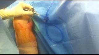 Arthroscopic Excision of Bakers Cyst JF Meyers M D [upl. by Yendis]