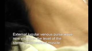 Usefulness of the External Jugular Vein Examination in Detecting Abnormal Central Venous Pressure in [upl. by Mohandis]