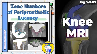 Fig 5D09 Specific Zone Numbers of Periprosthetic Lucency after TKA [upl. by Sidky]