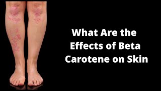 What Are the Effects of Beta Carotene on Skin [upl. by Sidman200]