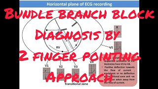 Diagnosis of Bundle branch block by two finger pointing approach by Dr Khaitan [upl. by Nosirb]