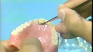 Replacing a Broken Complete Denture Tooth [upl. by Kciredec]