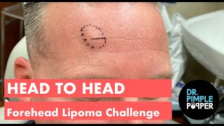 Head to Head Forehead Lipomas Challenge  Challenger 1 [upl. by Landis418]