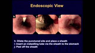 S079 A new procedure of esophagostomy for endoscopic surgeons  SS14 Therapeutic Endoscopy [upl. by Iduj268]