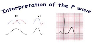 Interpretation of the P wave [upl. by Julis462]