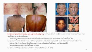 โรคเรื้อน Leprosy [upl. by Aramenta]