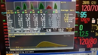 Cardiac output the longer version [upl. by Ligriv177]