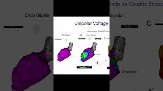 El Poder del Mapa Unipolar Detectando Cicatrices Ocultas en el Corazón Dra Carina Hardy [upl. by Anekam]