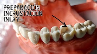 Preparación Incrustación dental Inlay [upl. by Niro861]