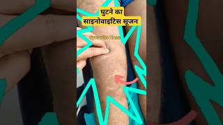 Normal Knee Vs Synovitis Knee🔥🔥घुटने में बड़ी सूजन का कारण kneeswellingeffusion kneejoint bone [upl. by Boy66]