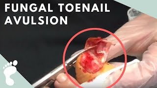 Fungal Toenail Nail Avulsion [upl. by Quinta]