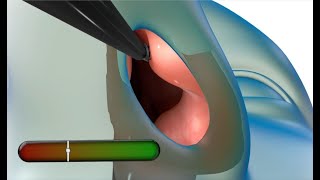 Vivaer nonsurgical procedure to help nasal congestion [upl. by Notxam]