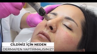 CİLDİNİZ İÇİN NEDEN DERMAPEN YAPTIRMALISINIZ [upl. by Ybbil934]