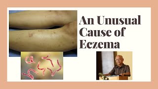 An unusual cause of eczema  Hookworm dermatitis [upl. by Natica]