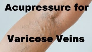 Acupressure Points for Varicose Veins  Massage Monday 356 [upl. by Neill872]