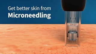 How Microneedling Improves Skin Firmness and Complexion Collagen Induction Therapy [upl. by Kostival]