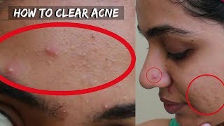 How to Get Rid of Pimples Acne  Marks in 3 Days  3 Home Remedies [upl. by Eivol]