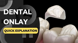 What is a Dental Onlay Quickly Explained in a Few Seconds [upl. by Alfonso76]