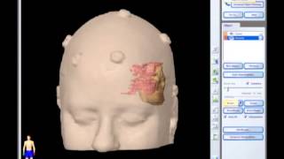 Removal of Brain Tumor Meningioma brain surgery [upl. by Ecyob]