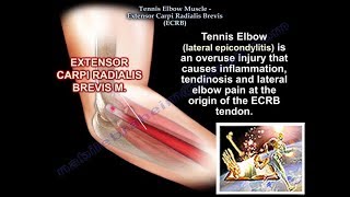 Tennis Elbow Extensor Carpi Radialis Brevis Everything You Need To Know  Dr Nabil Ebraheim [upl. by Yanej]