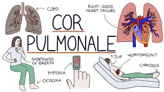 Understanding Cor Pulmonale [upl. by Allicirp]