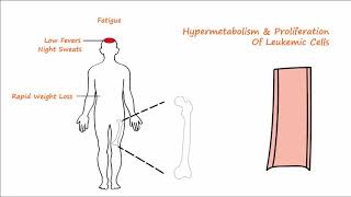 Acute Leukemia  Part 1 [upl. by Uahsoj]