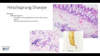 Colon Hirschsprung disease [upl. by Friedly234]