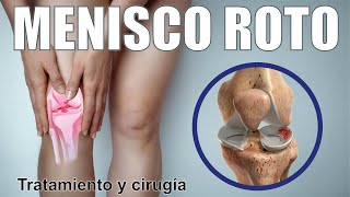 ROTURA de MENISCO 🦵🏼¿Cómo Saber Si Hay Una Lesión De Menisco 🦵🏼 Cirugía Terapia ⭐ Dr EDSON SERRANO [upl. by Ellekram]