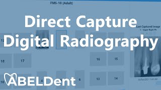 ABELDent Direct Capture Digital Radiography [upl. by Bensky844]