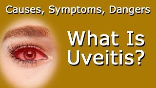 What Is Uveitis Causes Symptoms Dangers To Your Vision [upl. by Ameyn69]