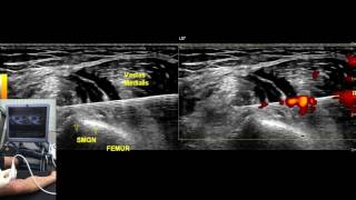 MSK US Guided Hydrodissection of Superomedial Genicular Nerve 2 [upl. by Darooge527]