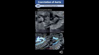 Coarctation of Aorta pediatric amp Adult [upl. by Fini]