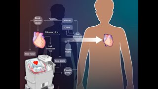 Outcomes with Donor Hearts after Circulatory Death  NEJM [upl. by Mayworm]