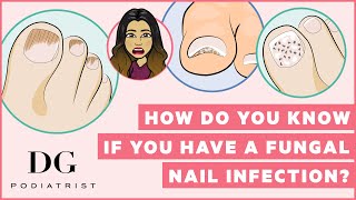 How do you know if you have a fungal nail infection [upl. by Asilav]