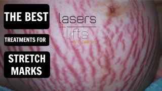 How To Remove Stretch Marks  Jism Ke Nishanat Ka Ilaj  Treatment Of Stretch Marks Kyun Hote Hain [upl. by Stefanie731]