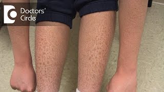 How to manage Ichthyosis Vulgaris in teenage boys  Dr Nischal K [upl. by Melentha]