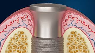 Effects of Different Abutment Morphologies on Periimplant Hard and Soft Tissue Behavior [upl. by Darrel]