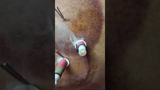 Moxibustion and needling For pain [upl. by Tugman595]