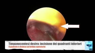 Otite media cronica glue ear aspirazione di secrezioni dalla cassa del timpano [upl. by Eitsirc]