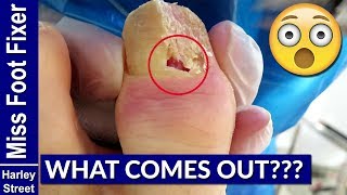 How to Treat Paronychia by Miss Foot Fixer Marion Yau [upl. by Kalasky89]